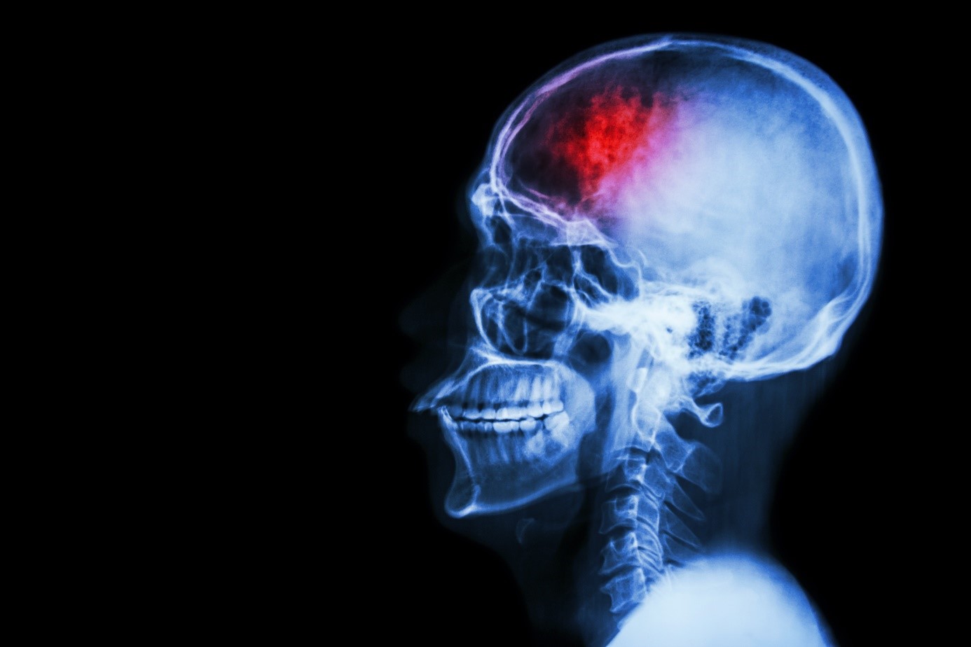 Какви са особеностите на рехабилитацията при черепно-мозъчна травма